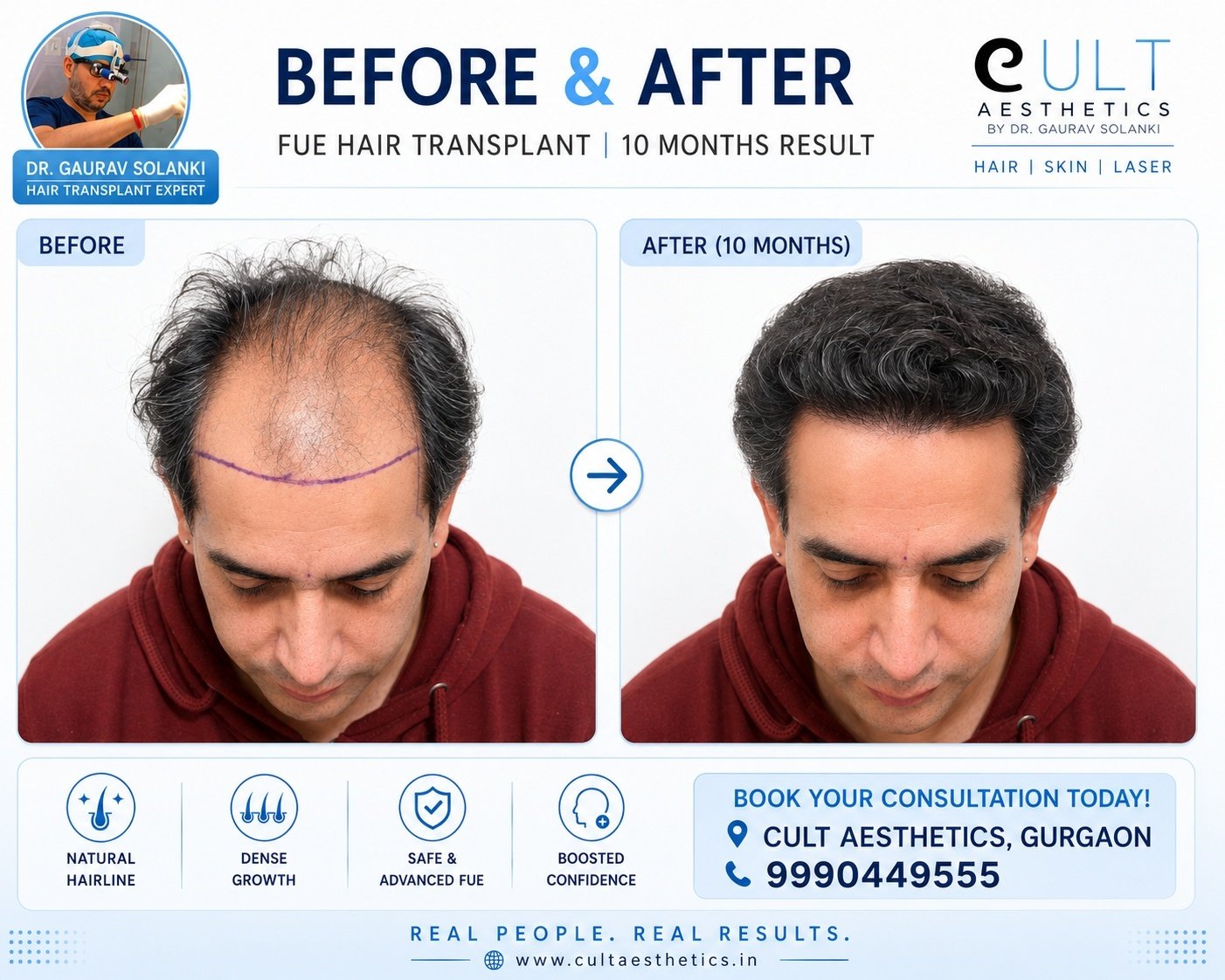 Australian patient FUE hair transplant before and after, Cult Aesthetics Gurgaon