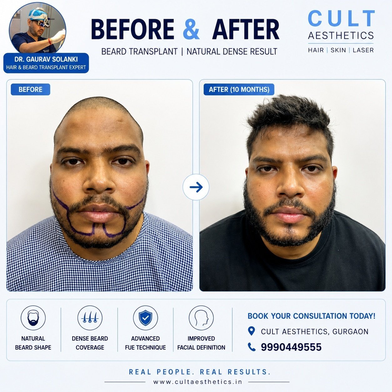 Beard transplant before and after, Cult Aesthetics Gurgaon