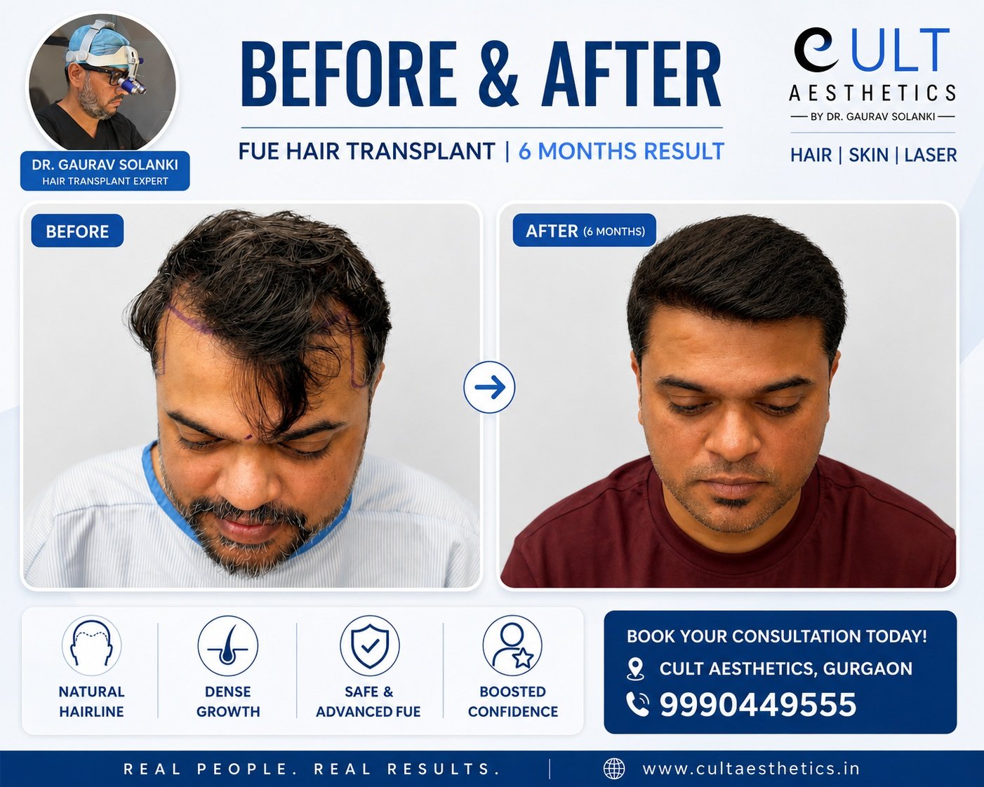 FUE hair transplant before and after, 6 months, Cult Aesthetics Gurgaon