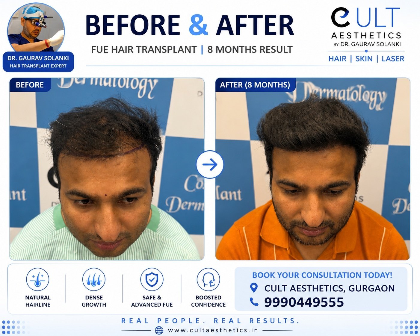 Corrective hair transplant result at Cult Aesthetics Gurgaon for a patient whose previous transplant in Turkey did not meet expectations, by Dr. Gaurav Solanki