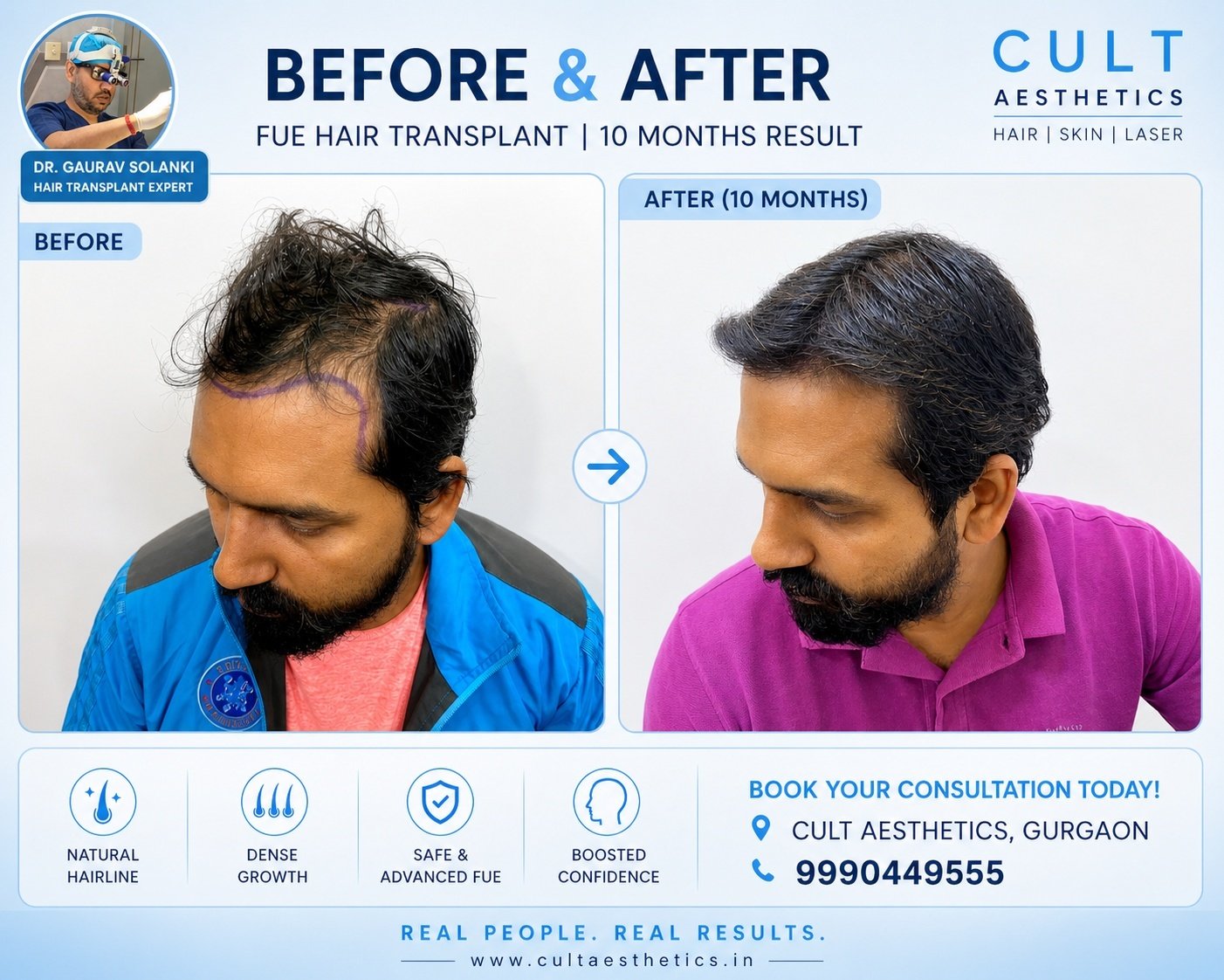 FUE hair transplant before and after result, Cult Aesthetics Gurgaon