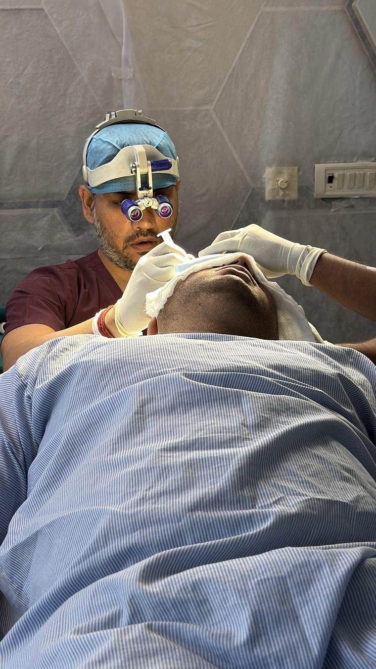 Dr Gaurav Solanki performing FUE hair transplant graft extraction in Gurgaon