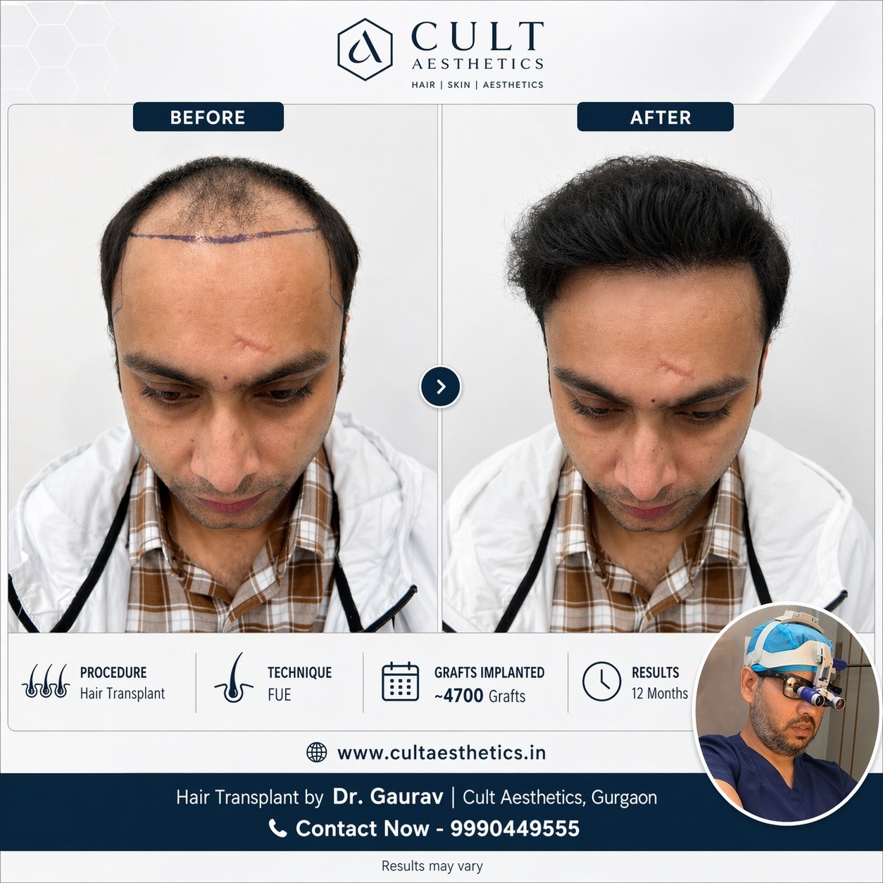 FUE hair transplant before and after, approximately 4700 grafts, 12 months, Cult Aesthetics Gurgaon